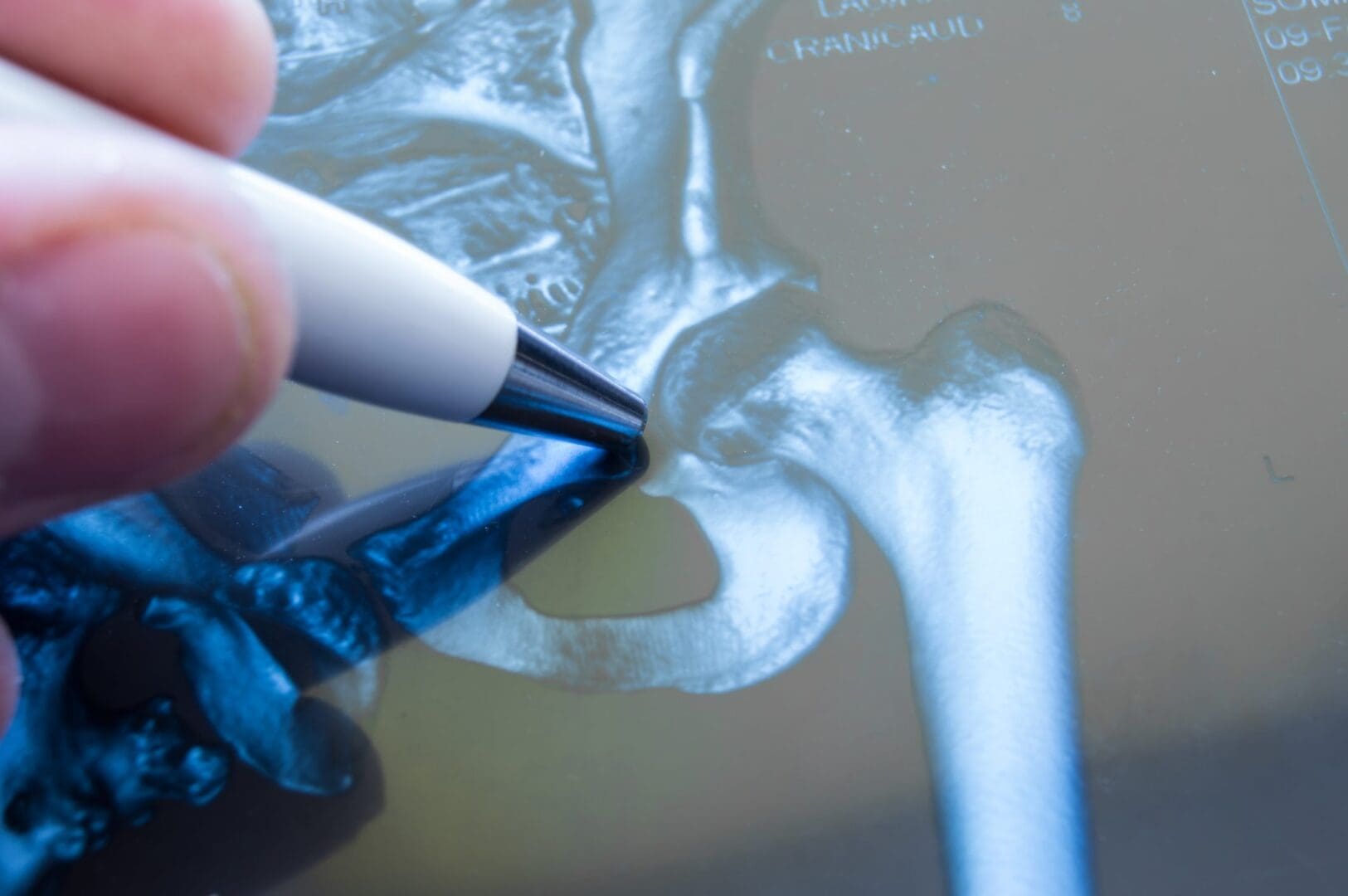 Hip joint X-ray highlighting the area requiring surgical treatment.